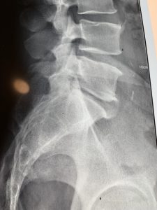 Bandscheibenvorfall L5 / S1